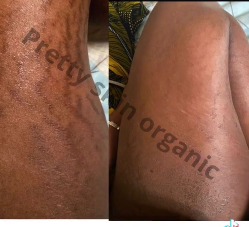 Gel noir anti vergetures